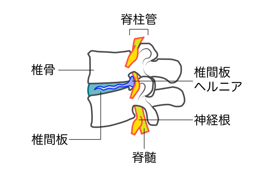 椎間板ヘルニア